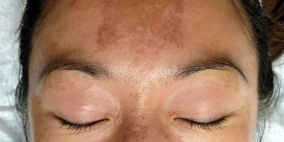 melasma-ook-bekend-als-zwangerschapsmasker-instituut-marlotte